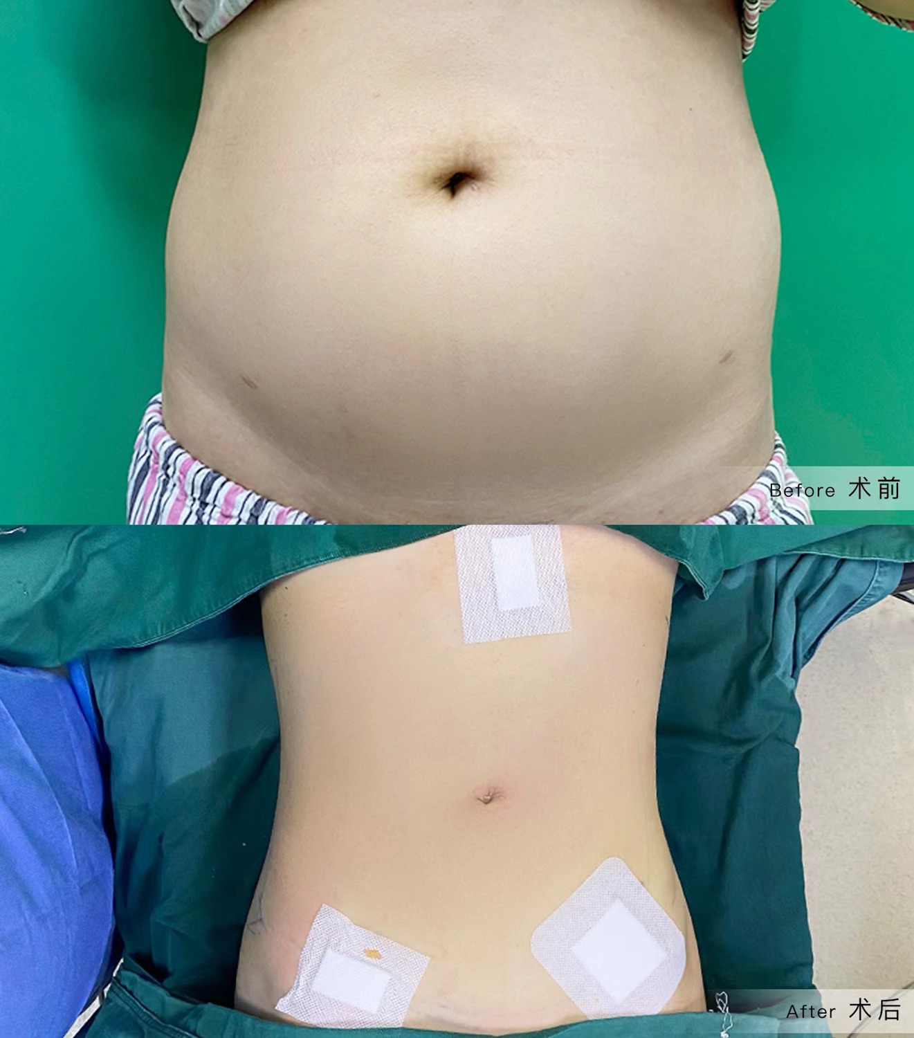 腹部环吸